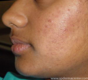 PIH-Acne-After
